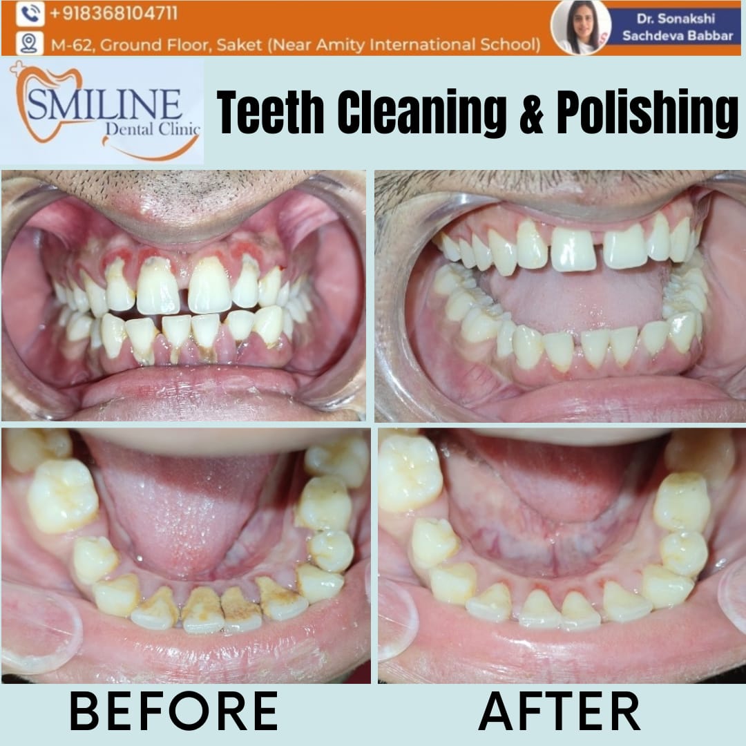 Braces treatment at Smiline Dental Clinic Saket South Delhi